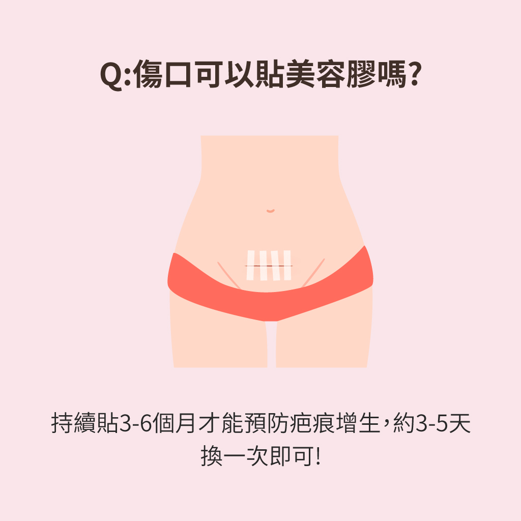 剖腹產傷口可以貼美容膠嗎?