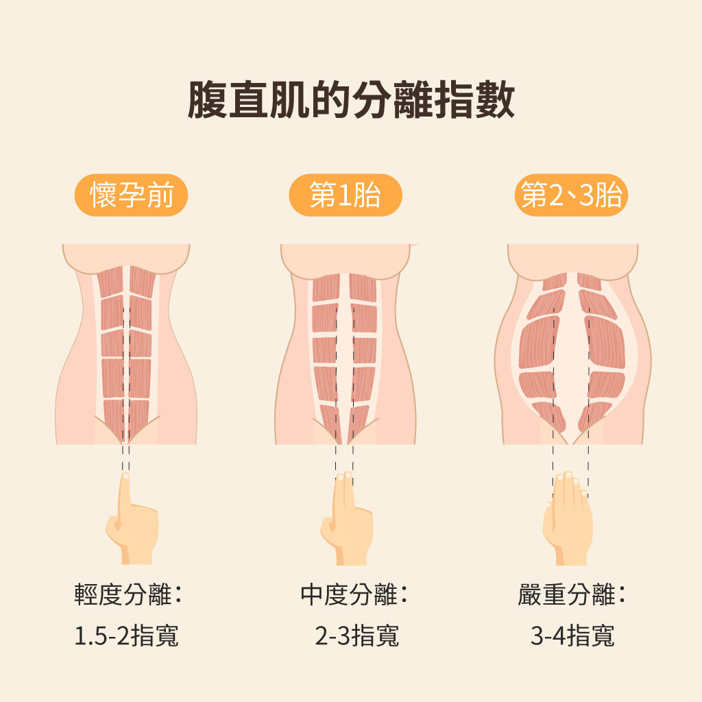 腹直肌分離指數