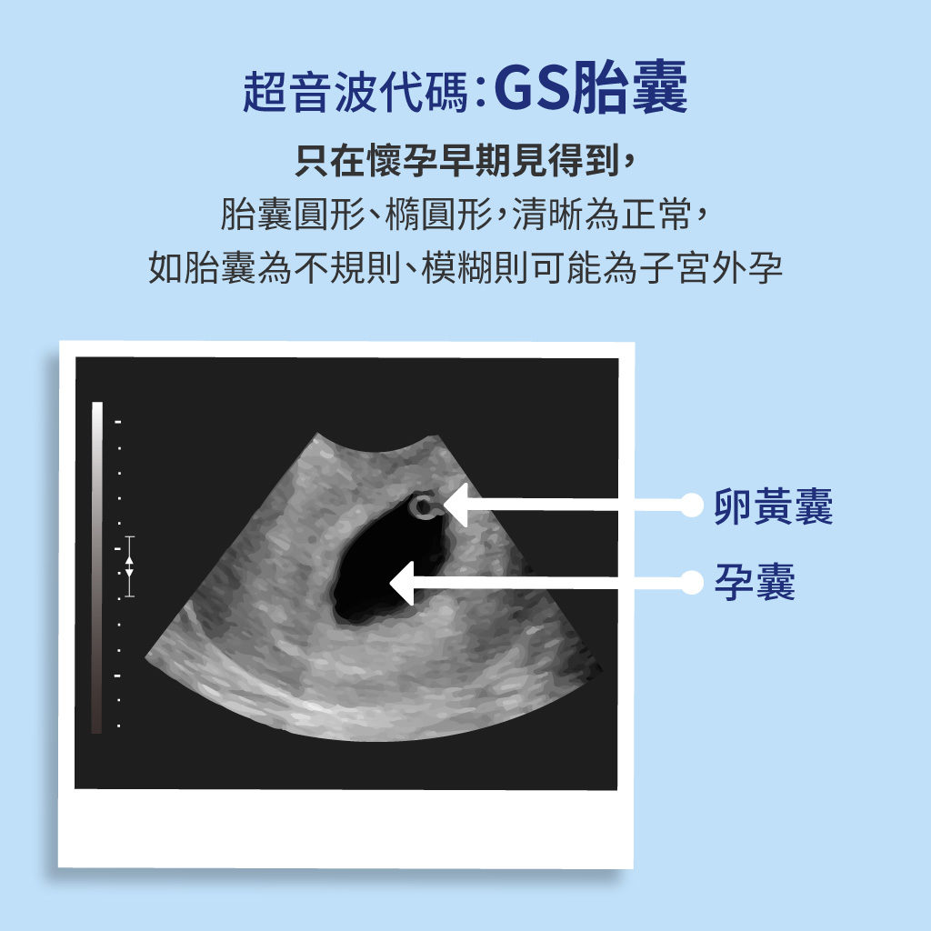 產檢超音波GS