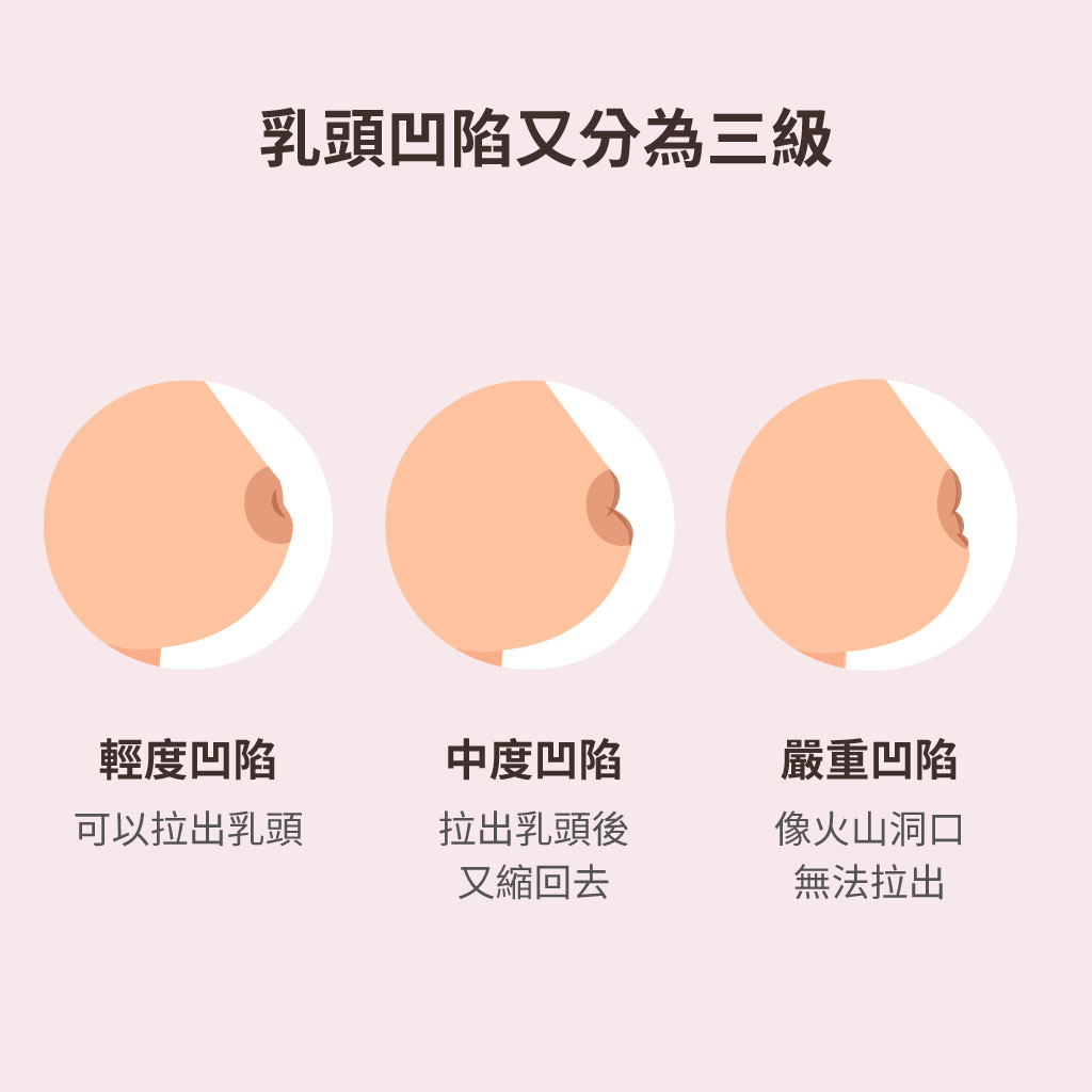52+ 图片 乳頭 新的 12 乳頭凹陷沒有奶頭怎麼辦?學會3招依然可以順利哺乳! - mamaway