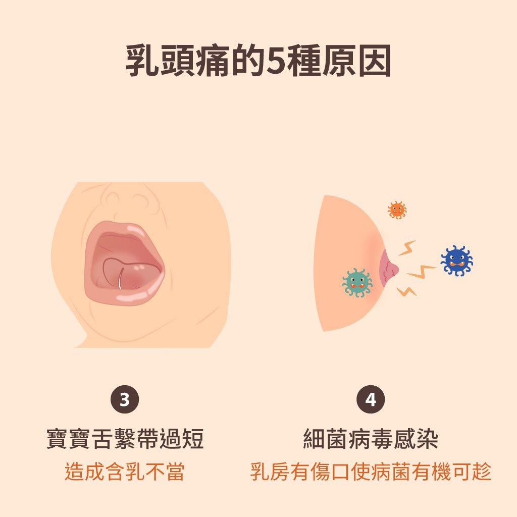 乳頭痛可能是這5種原因，哺乳乳頭痛媽咪該怎麼辦呢? - mamaway