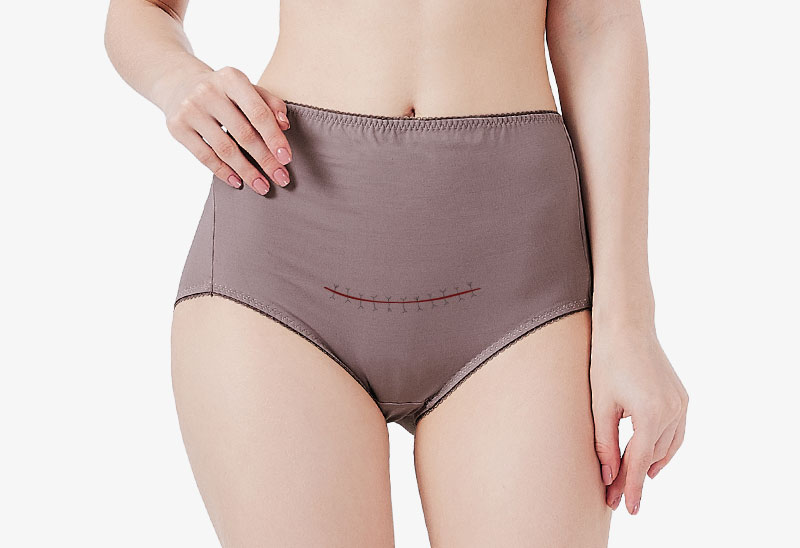 適合剖腹產復原